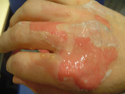 <h1>The Best Tips for Treating Burns in a Crisis</h1>